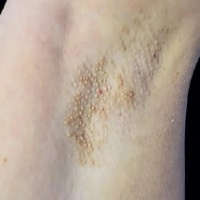 Białe grudki pod pachami choroba Foxa-Fordyce'a