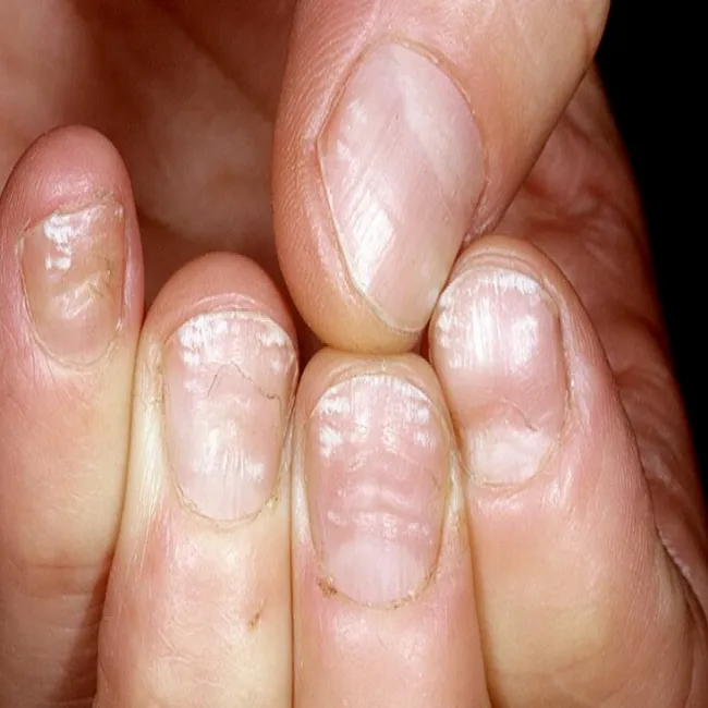 Białe paznokcie choroba leukonychia 