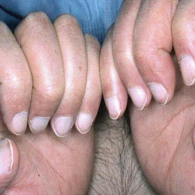Białe paznokcie choroba