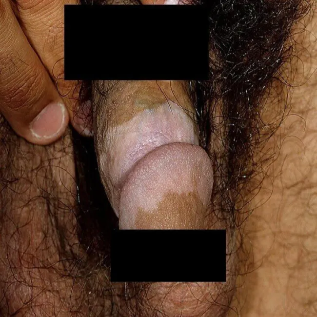 Białe plamy miejsc intymnych u meżczyzn