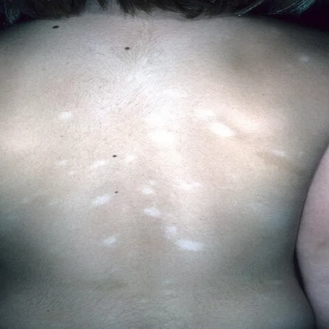 Białe plamy na plecach