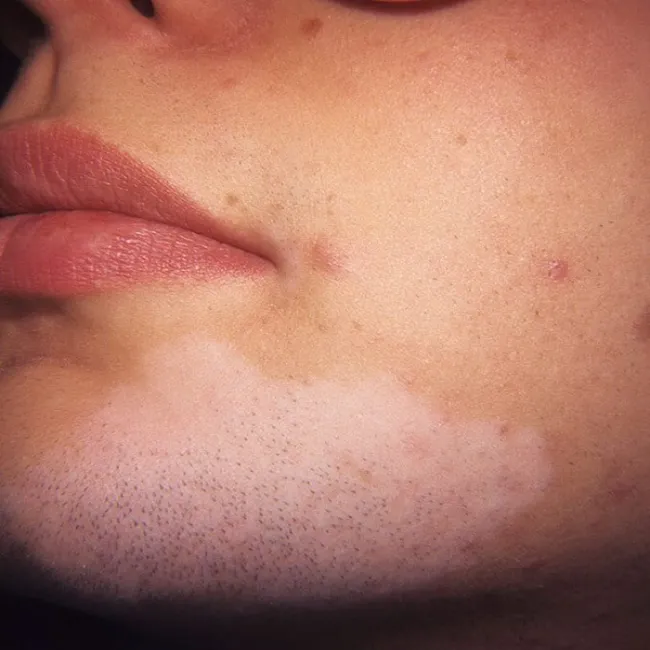 Białe plamy na skórze brody