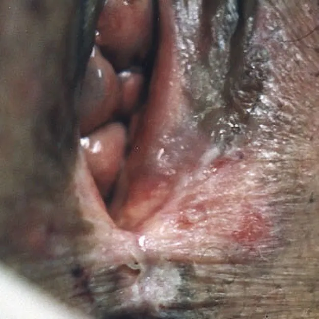 Białe zmiany na wargach sromowych leukoplakia sromu