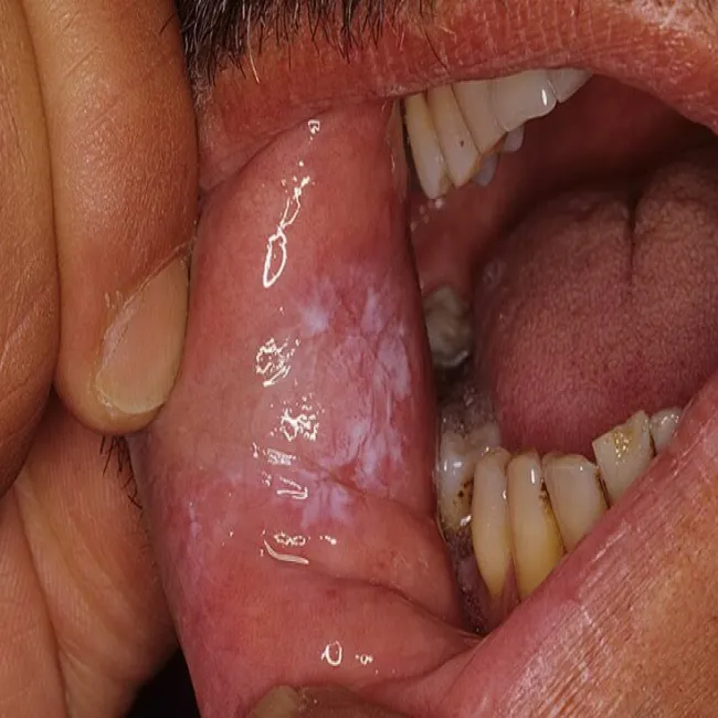 Biały nalot na poliku wewnątrz