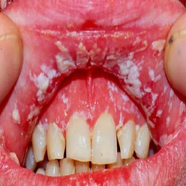 Biały nalot w jamie ustnej