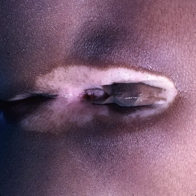 Bielactwo miejsc intymnych kobiet