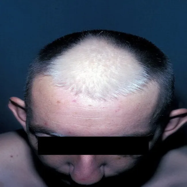 Bielactwo na głowie