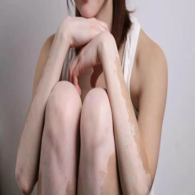 Bielactwo na nogach i rękach