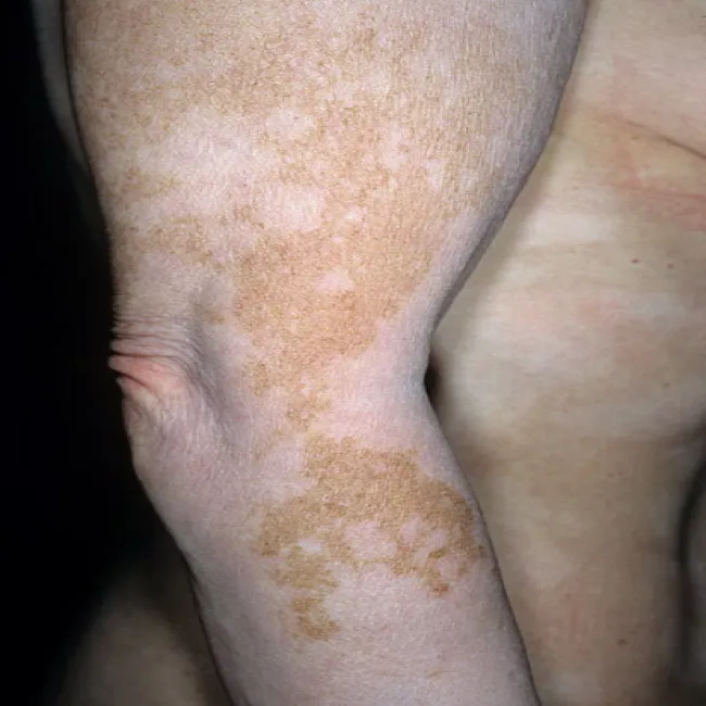 Bielactwo na skórze 