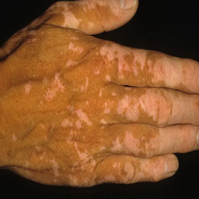 Bielactwo nabyte dłoni