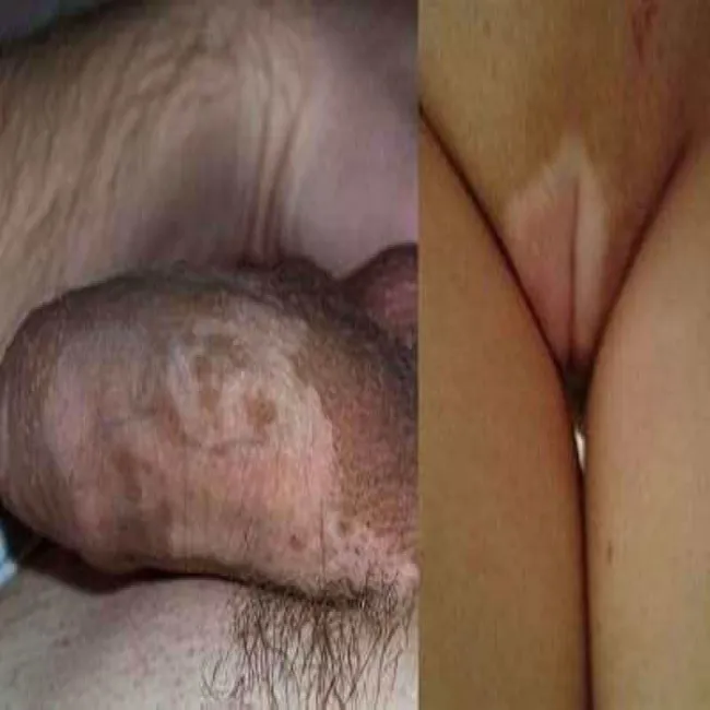 Bielactwo narządów płciowych zdjęcia