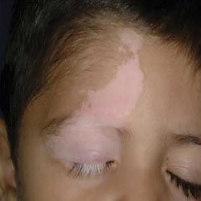 Bielactwo wrodzone u dziecka