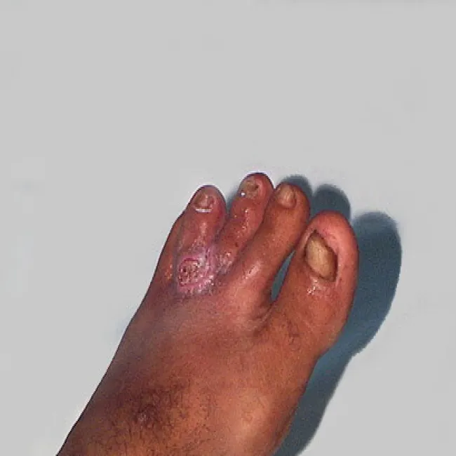 Blastomykoza choroba 