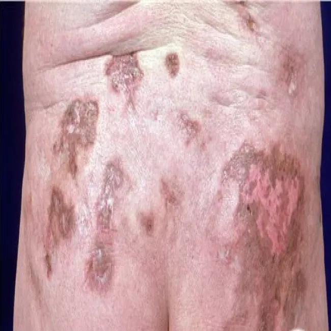 Blastomykoza przewlekła choroba ropna, ziarniniakowa