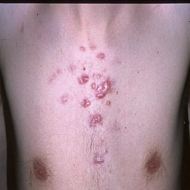 Bliznowiec na klatce piersiowej