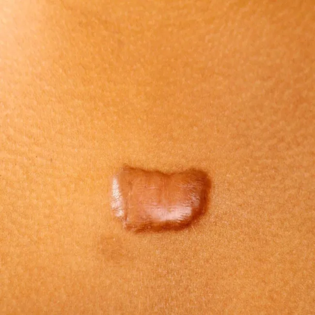 Bliznowiec na skórze