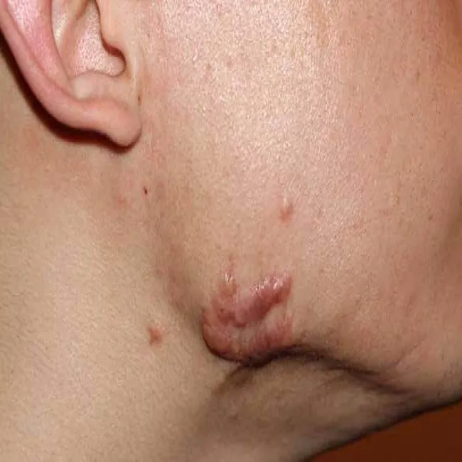 Bliznowiec na twarzy