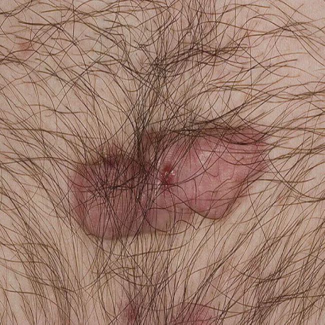 Bliznowiec w miejscu intymnym