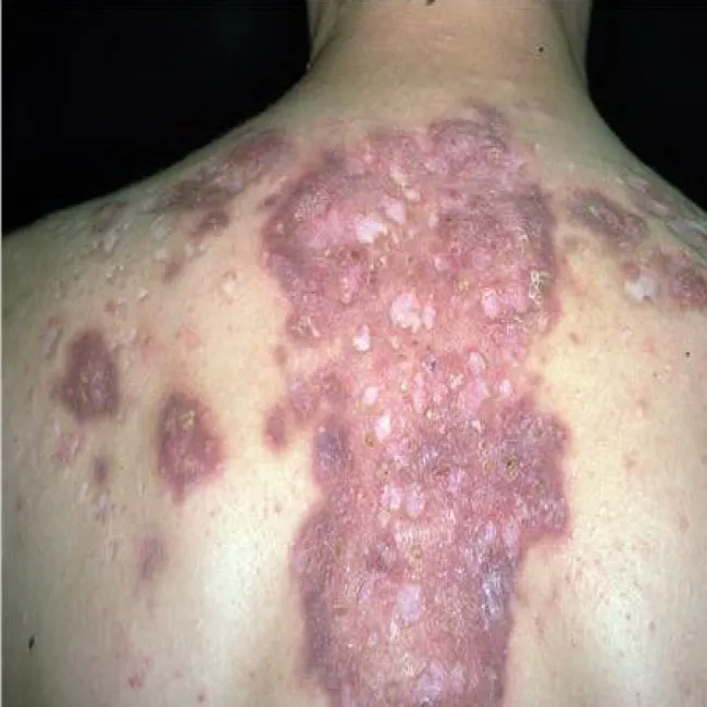 Blizny na plecach Trądzik skupiony 