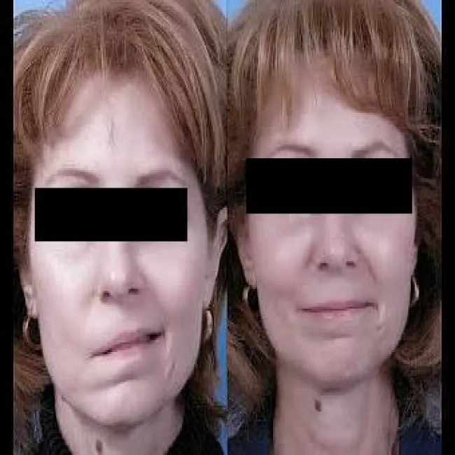 Borelioza objaw na twarzy