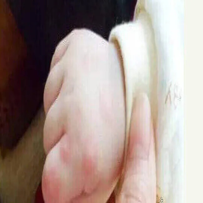 Bostonka choroba na dłoniach u niemowlaka