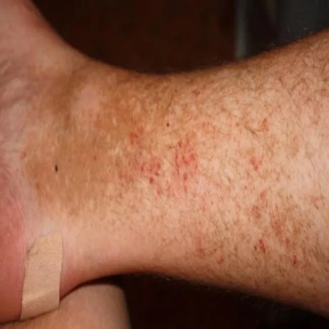 Brązowe plamy i wysypka na skórze nóg 