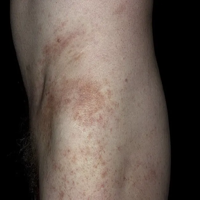 Brązowe plamy na ciele 