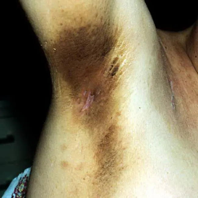 Brązowe plamy pod pachami