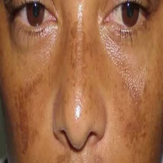 Brązowe przebarwienia na skórze choroba Addisona