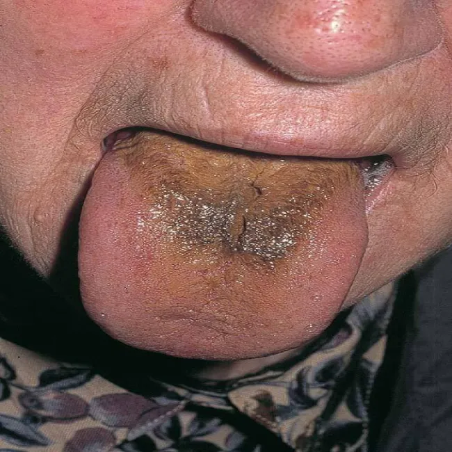 Brązowy nalot na języku