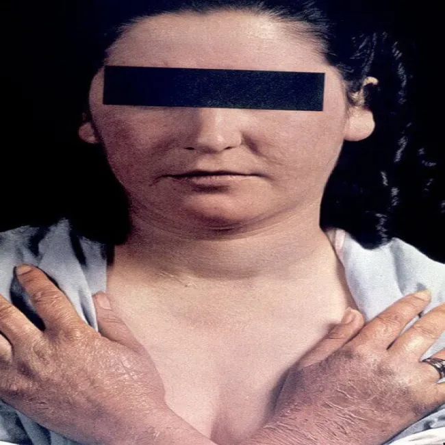 Brak niacyny szorstka skóra