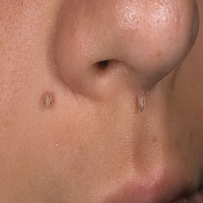 Brodawka nitkowata pod nosem