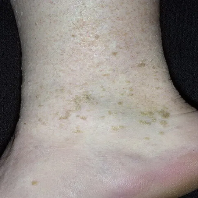 Brodawki łojotokowe na nodze