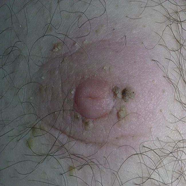 Brodawki łojotokowe na piersiach u mężczyzn