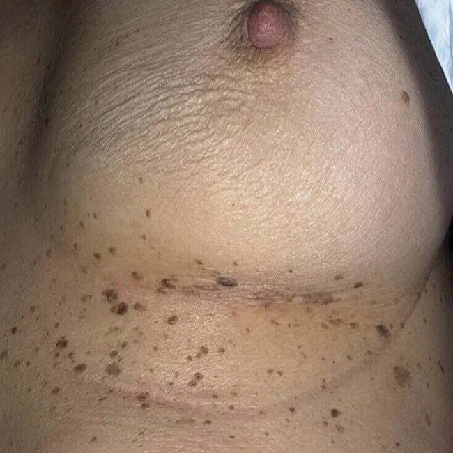 Brodawki łojotokowe pod piersiami