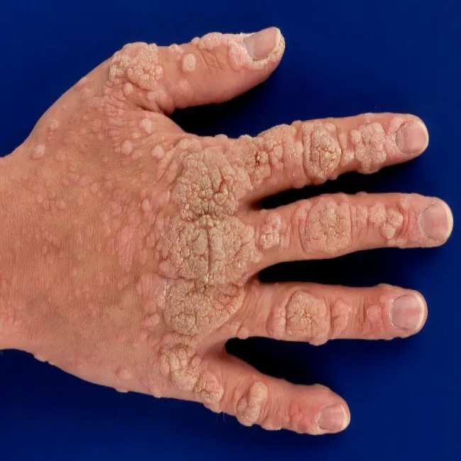 Brodawki dłoń