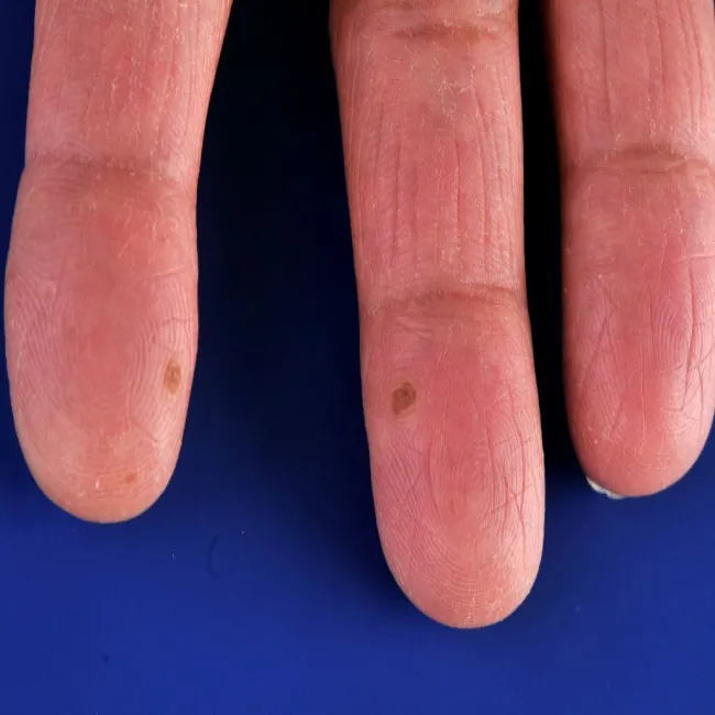 Brodawki na palcach dłoni