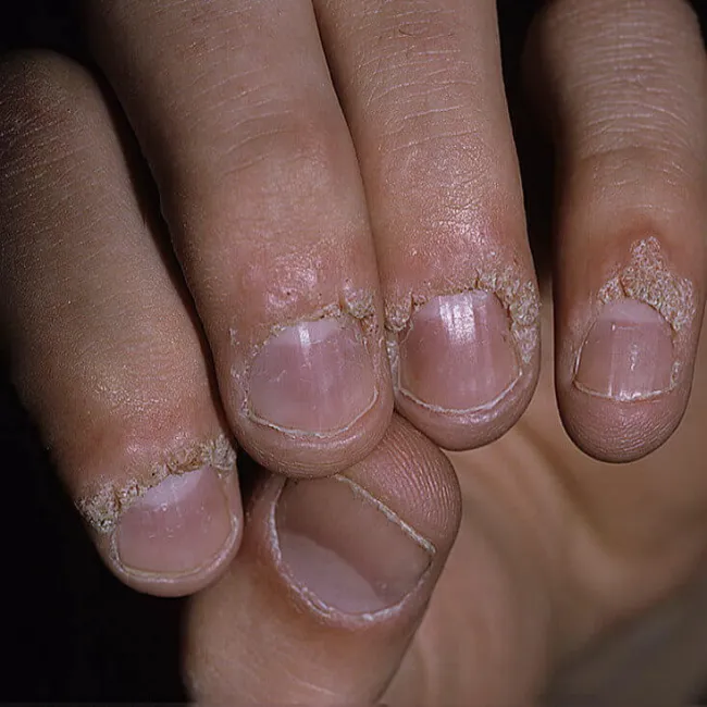 Brodawki na palcach dłoni