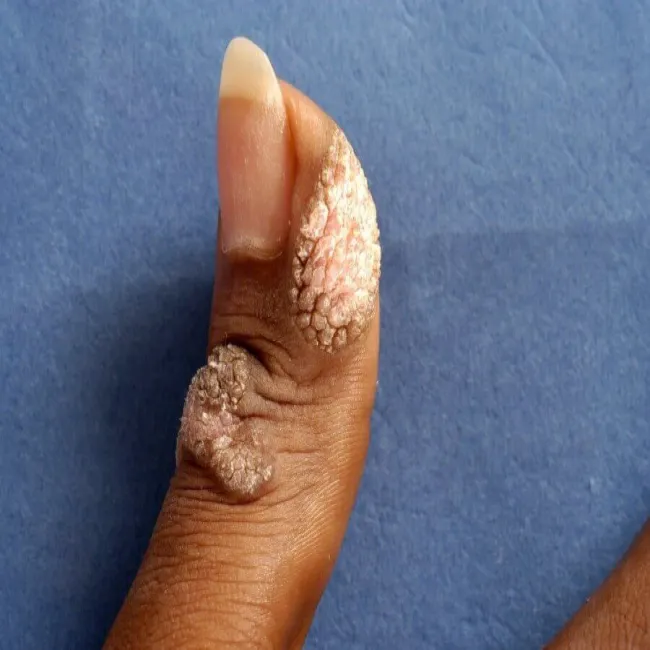 Brodawki na palcu