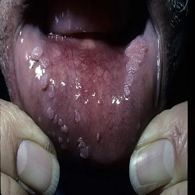 Brodawki na wardze ust