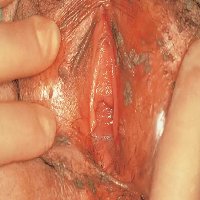 Brodawki płciowe u kobiet