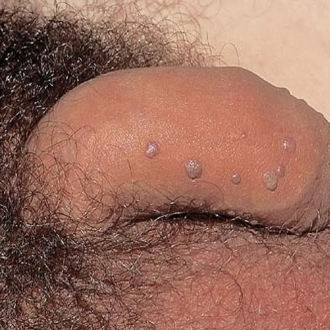 Brodawki płciowe u mężczyzn