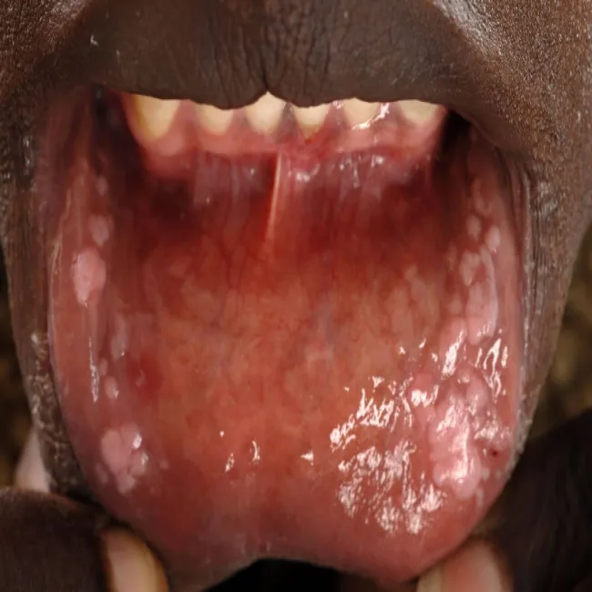 Brodawki weneryczne jamy ustnej