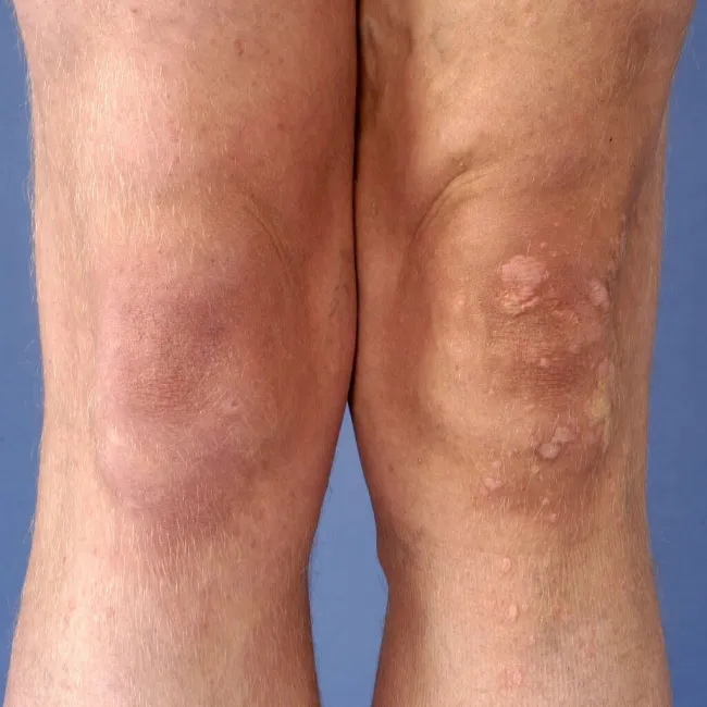 Brodawki zwykłe na nogach