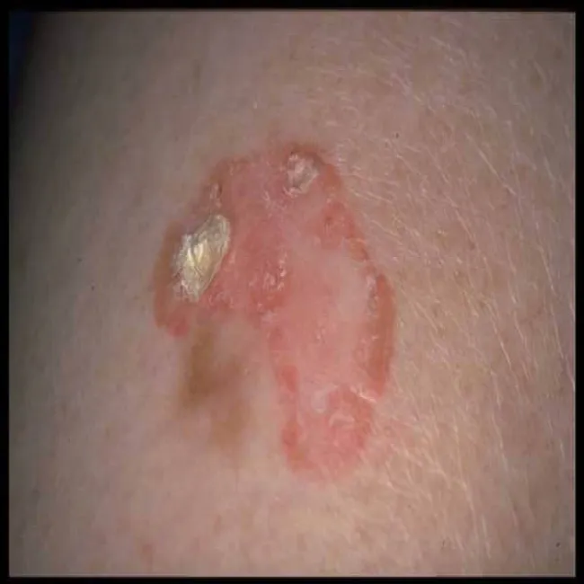 Carcinoma basocellulare exulceratum