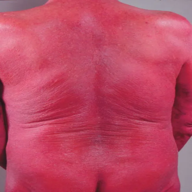 Chłoniak T-komórkowy zespół Sezary’ego 