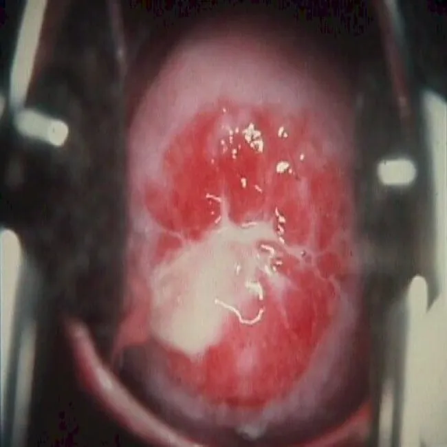 Chlamydia szyjki macicy