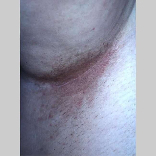 Choroba łupież rumieniowy 