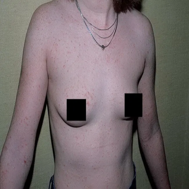 Choroba świerzb u nastolatki