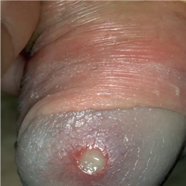 Choroba Behçeta na męskich genitaliach